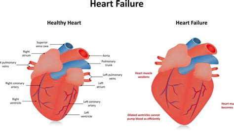 hypokinetic lv|hypokinesis of left ventricle cause.